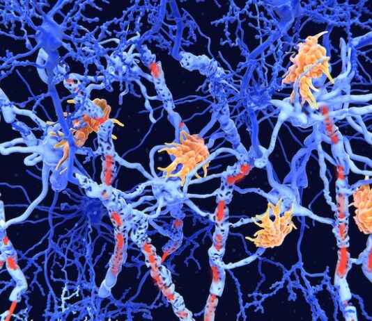 Developed by US researchers: New procedure is intended to detect multiple sclerosis before symptoms begin