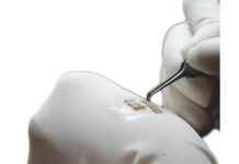 FUE Hair Transplantation: A Comprehensive Guide to Restoring Hair Naturally FUE Hair Transplantation: A Comprehensive Guide to Restoring Hair Naturally