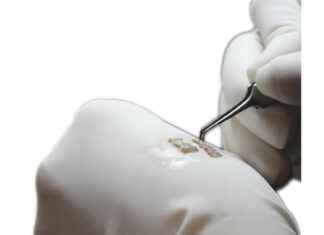 FUE Hair Transplantation: A Comprehensive Guide to Restoring Hair Naturally FUE Hair Transplantation: A Comprehensive Guide to Restoring Hair Naturally