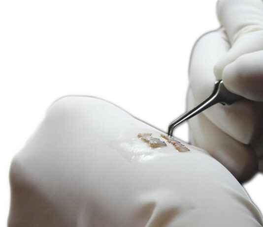 FUE Hair Transplantation: A Comprehensive Guide to Restoring Hair Naturally FUE Hair Transplantation: A Comprehensive Guide to Restoring Hair Naturally